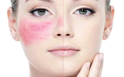 imagen-hydrafacial-blog-400x250